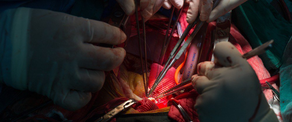 Aortic Aneurysm Repair